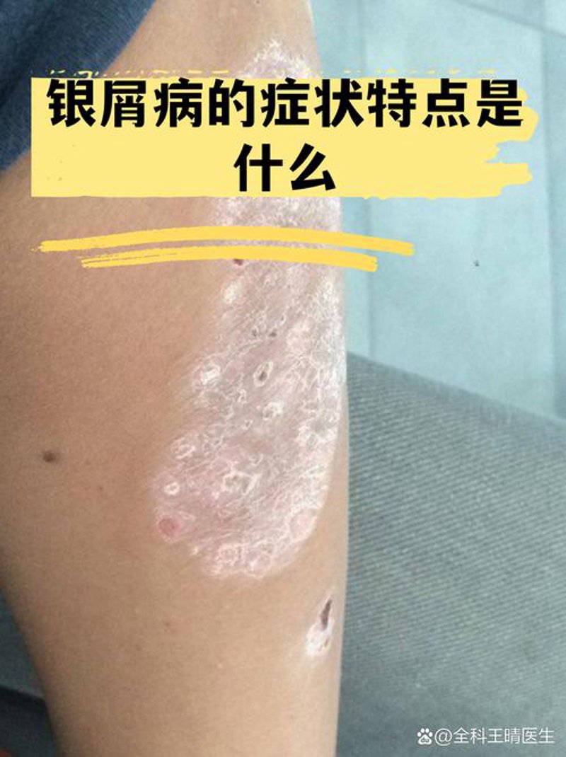 祛痘选购指南：如何选对合适的产品？