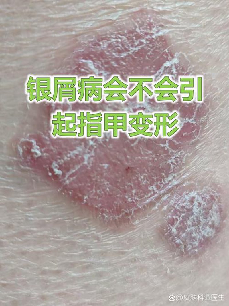 银屑病