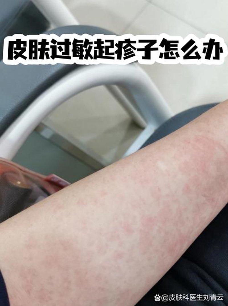 祛痘新趋势：自然与科技的完美融合