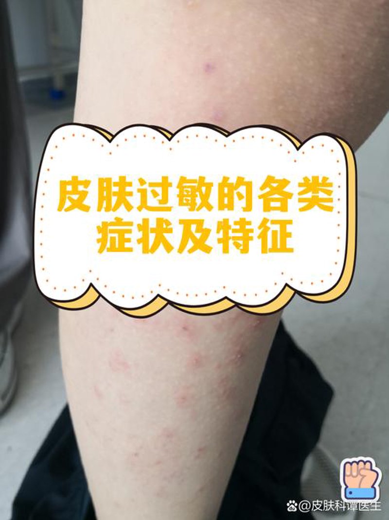 湿疹治疗：常见问答及应对策略