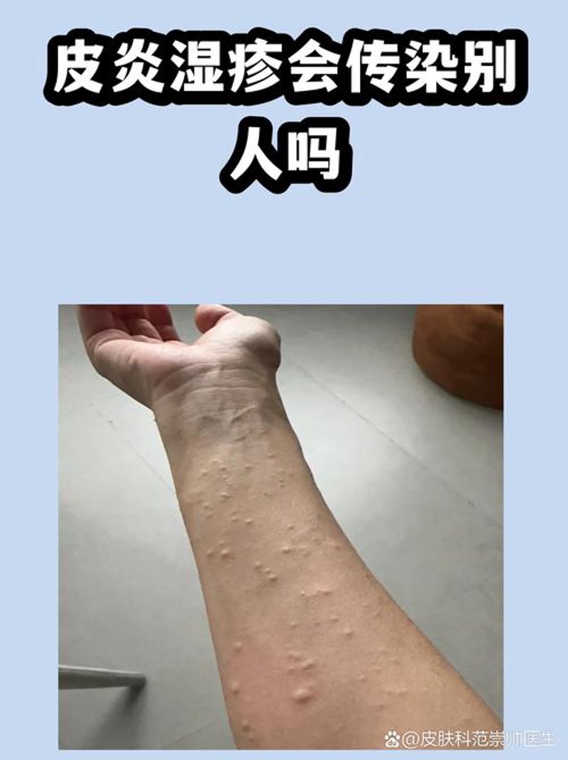 祛痘妙招：面对青春烦恼的美丽秘诀