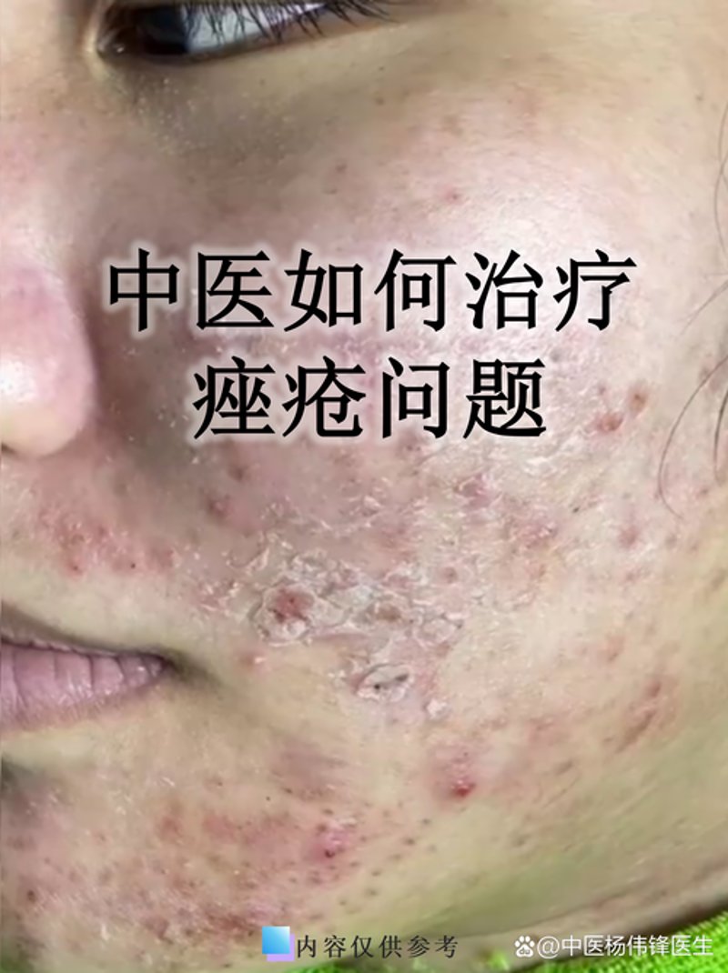 痤疮治疗那些事儿