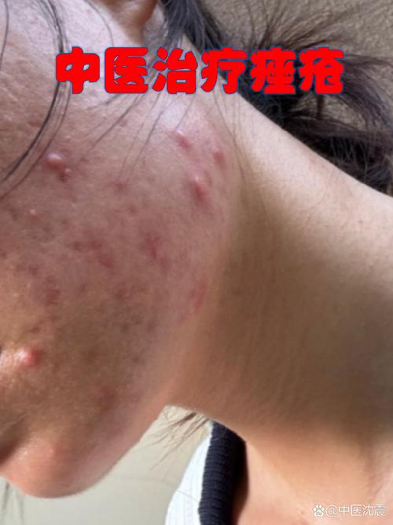 治疗痤疮