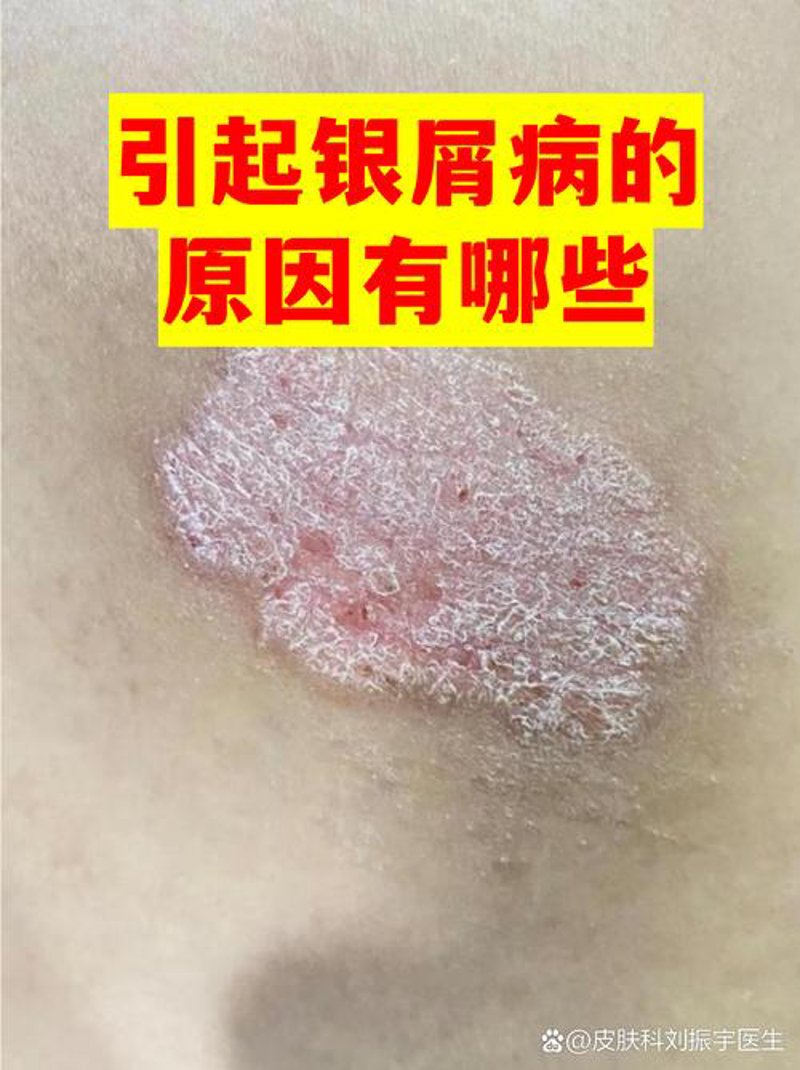 改善肌肤难题：治疗痤疮的几个实用技巧