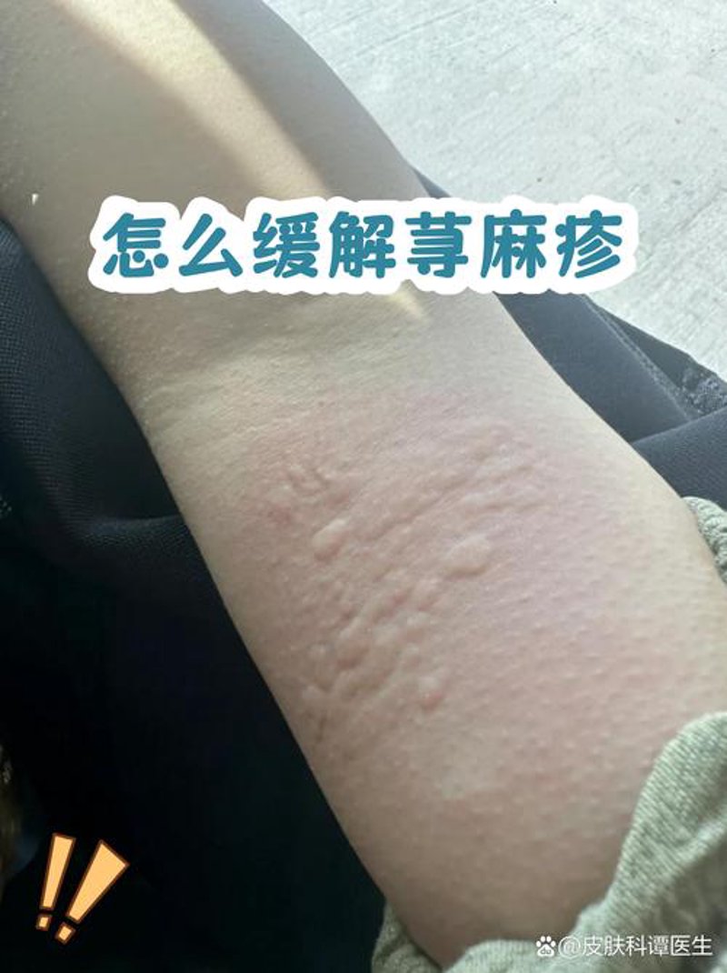 痤疮治疗新进展：科技引领美丽