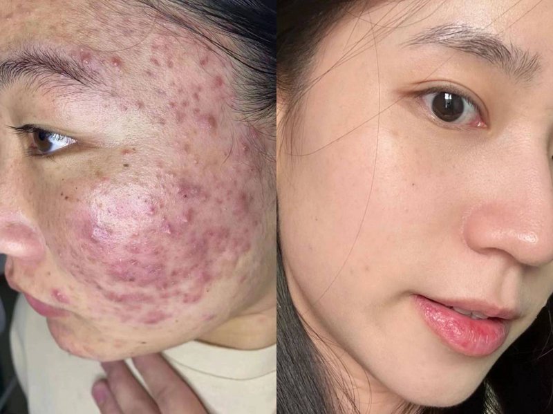 祛痘秘方：从案例中寻找有效的护肤之道