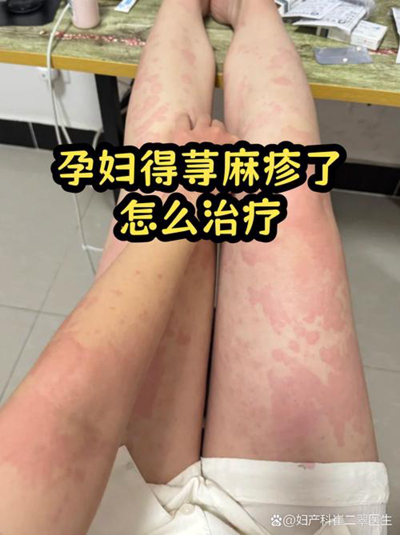 当代青年皮肤困扰：那些关于治疗痤疮的最新进展