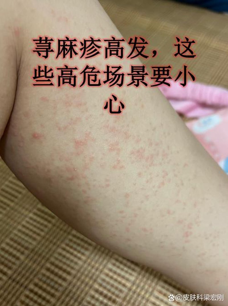 湿疹治疗新趋势：从传统的药物到现代的疗法